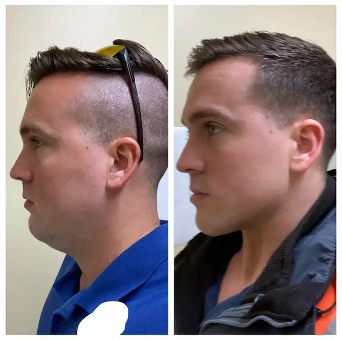 Montage avant/après d’un homme : à gauche, il a une mauvaise posture et une mâchoire peu définie, à droite, grâce au mewing, sa posture est redressée, son visage sculpté et sa mâchoire redéfinie, le rendant plus droit et plus beau.